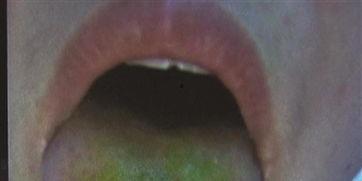 吃瓜后舌苔麻木,揭秘吃瓜后舌苔麻木之谜